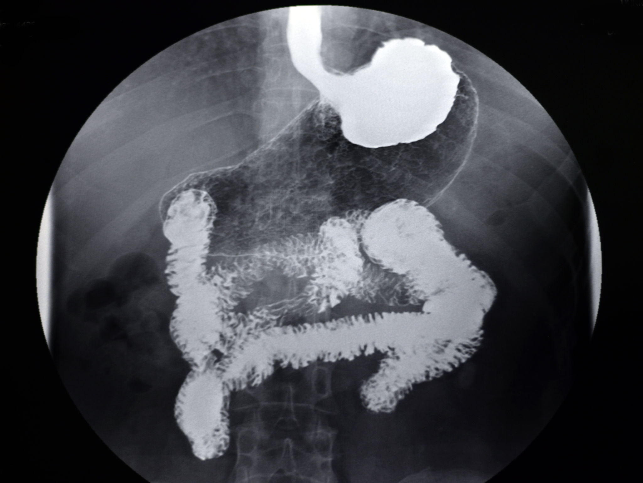 My Esophagus and Me Facebook ad