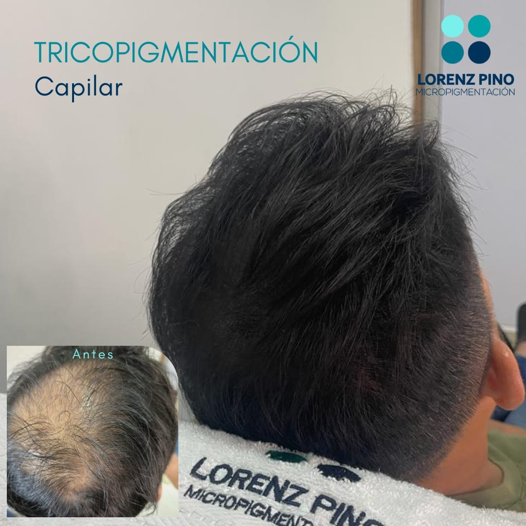 Lorenz Pino Facebook ad: Tricopigmentación