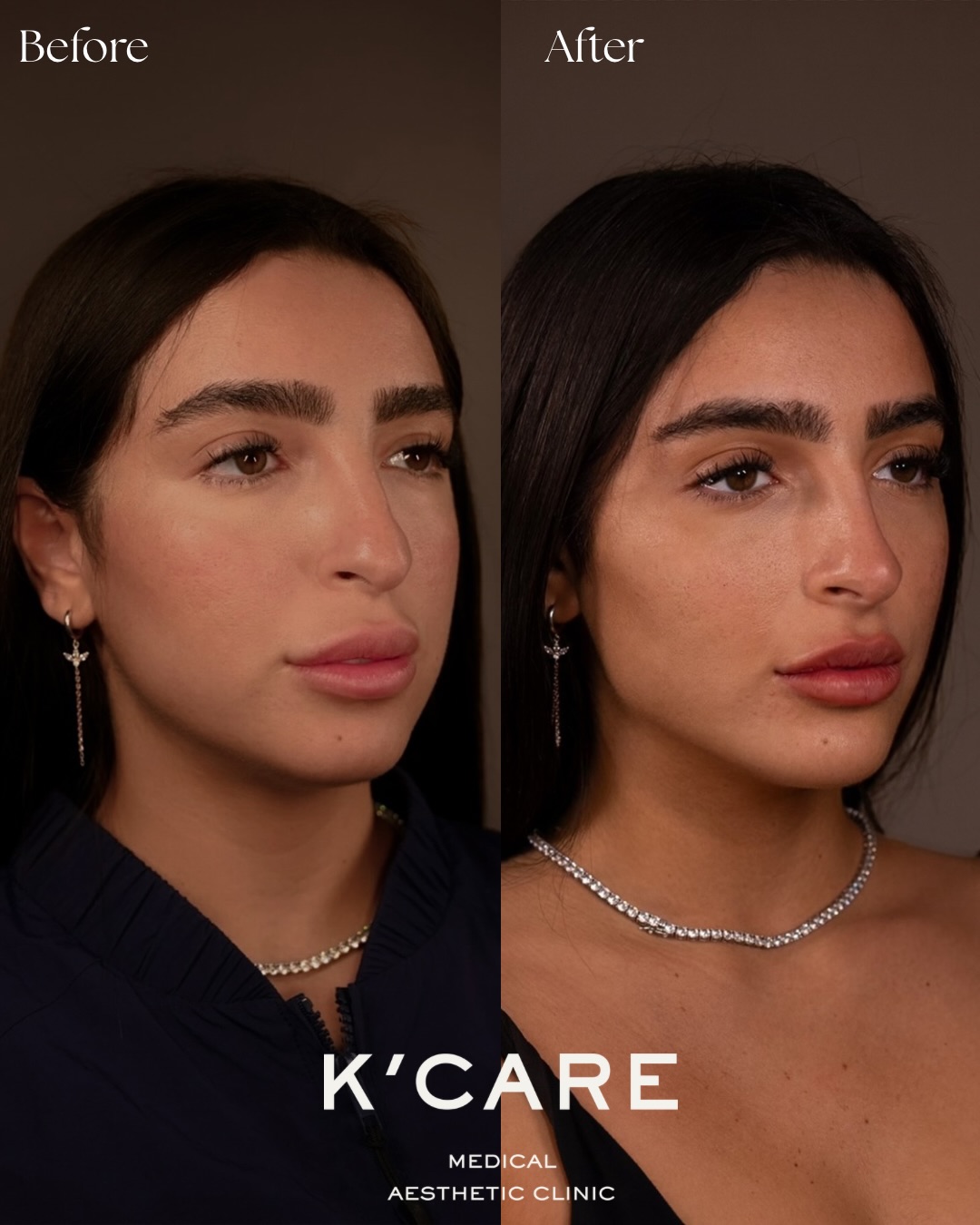K-care. Facebook ad: השינוי ההורס של רותם כמה נקודות הזרקה שמשנות…