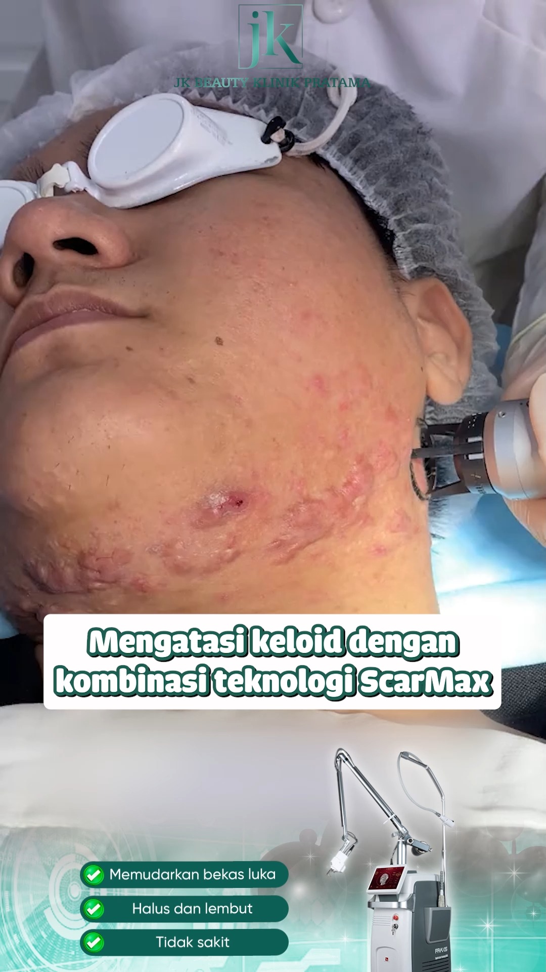 Scarmax - JK Beauty Klinik Pratama Facebook ad: Bekas luka keloid akibat jerawat bikin kamu kehilangan…