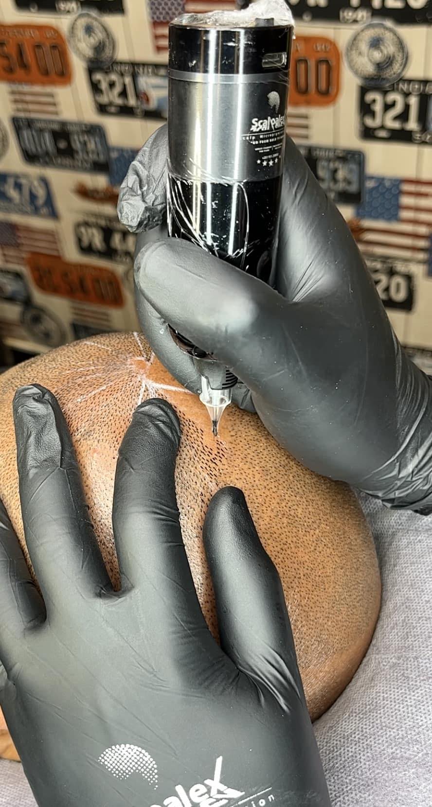 Scalpalex Scalp Micropigmentation Facebook ad: የረቀቀ የፀጉር ታቱ(Scalp Micropigmentation)