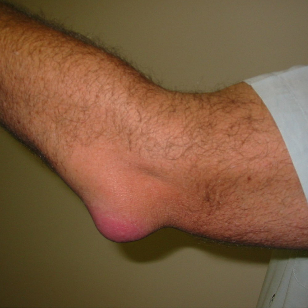 Thomas Bergmann Facebook ad: 3 Years of Chronic Pain. Gone in 3 Weeks.