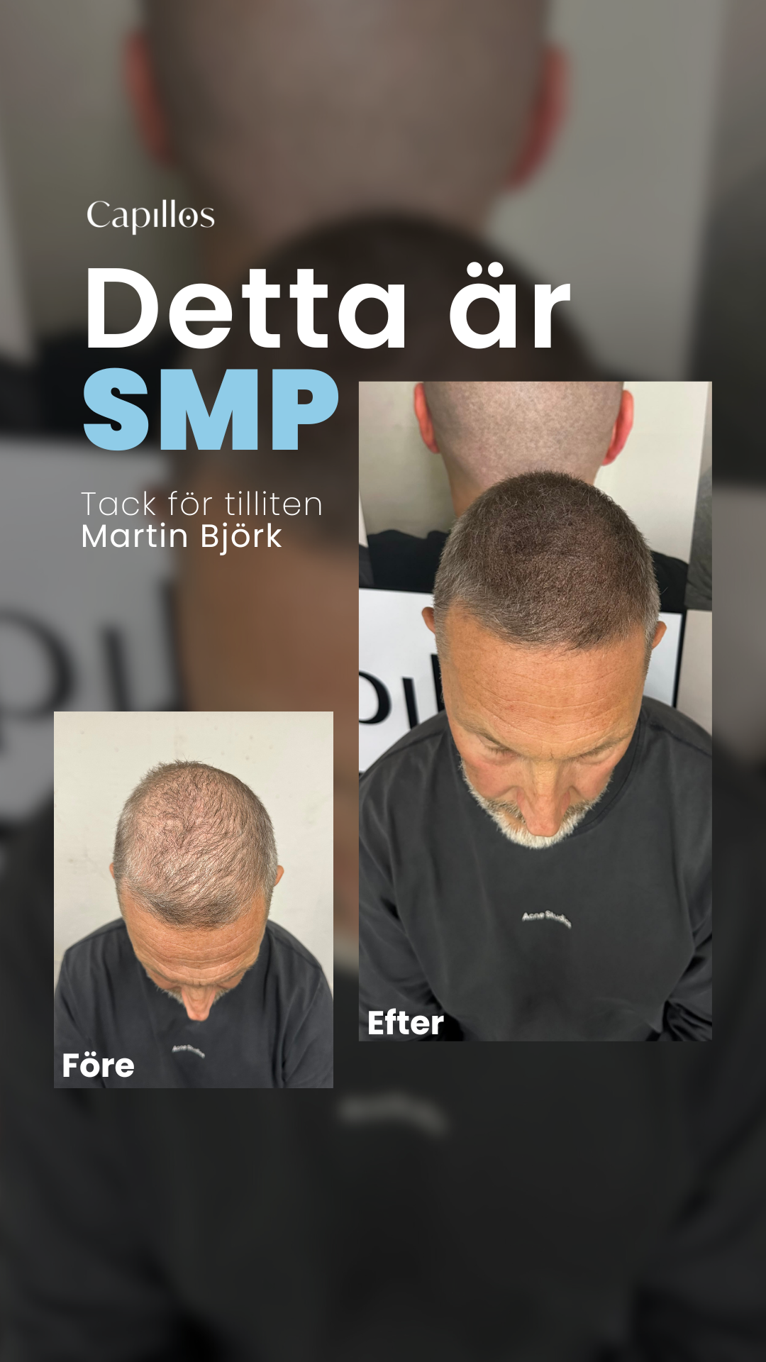 Scalp Micropigmentation Capillos Facebook ad from Feb 24, 2026