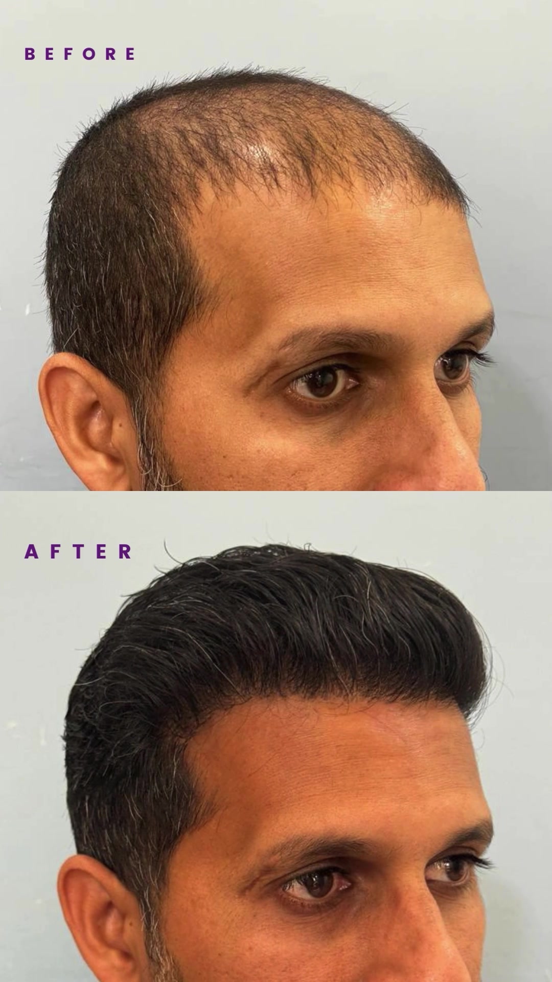 Before and Afters by Cocoona Facebook ad: Get Natural-Looking Hair with Advanced FUE Hair Transplant.