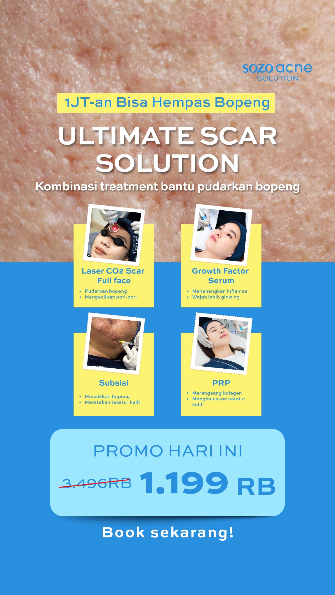 Sozo Acne Facebook ad