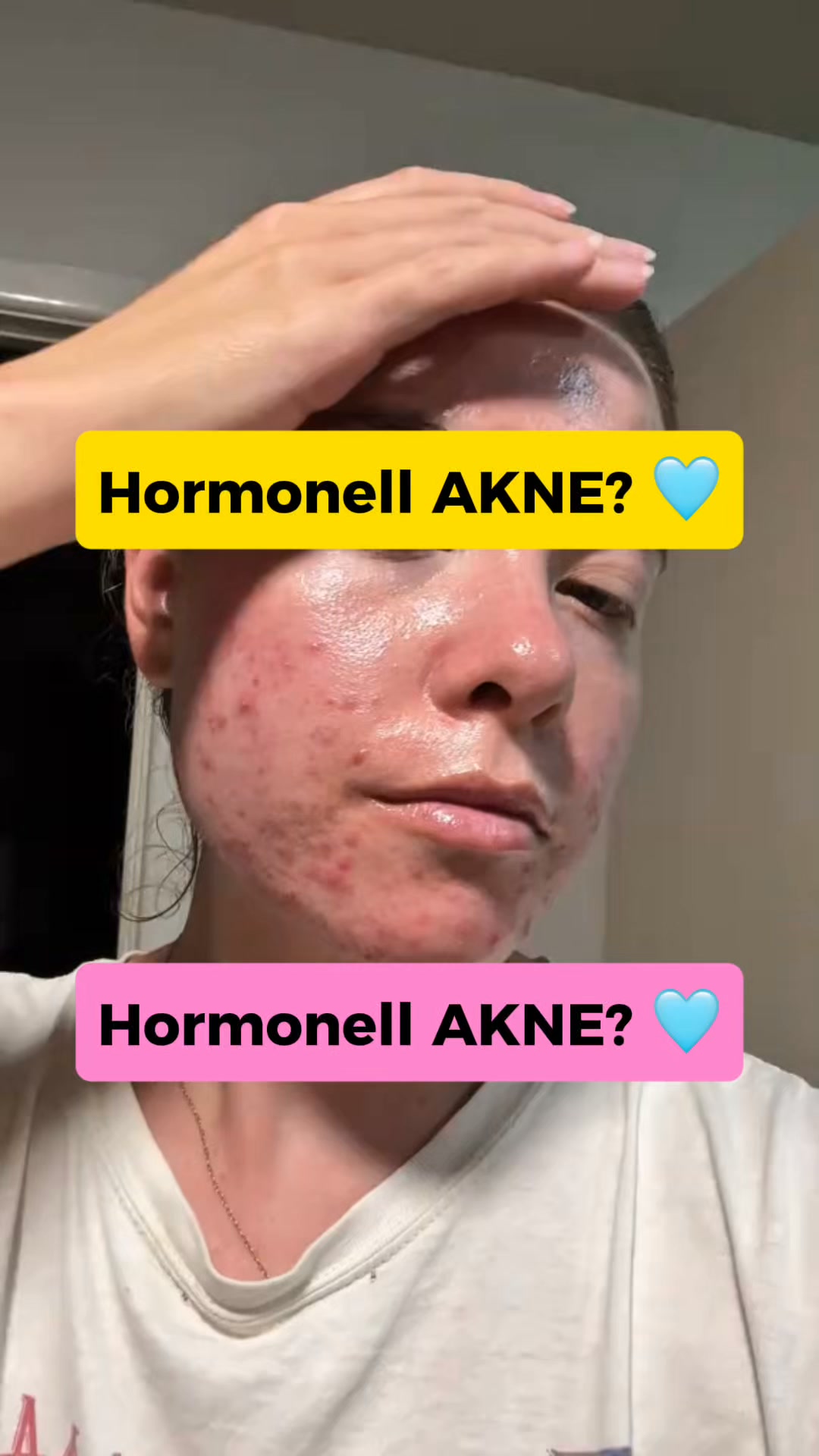LovieBaby Facebook ad: Naturlig hudvård för akne