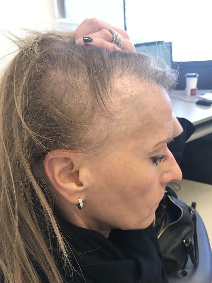 Lilly Bennett Facebook ad: The Window To Save Your Hair Is Smaller Than You Think