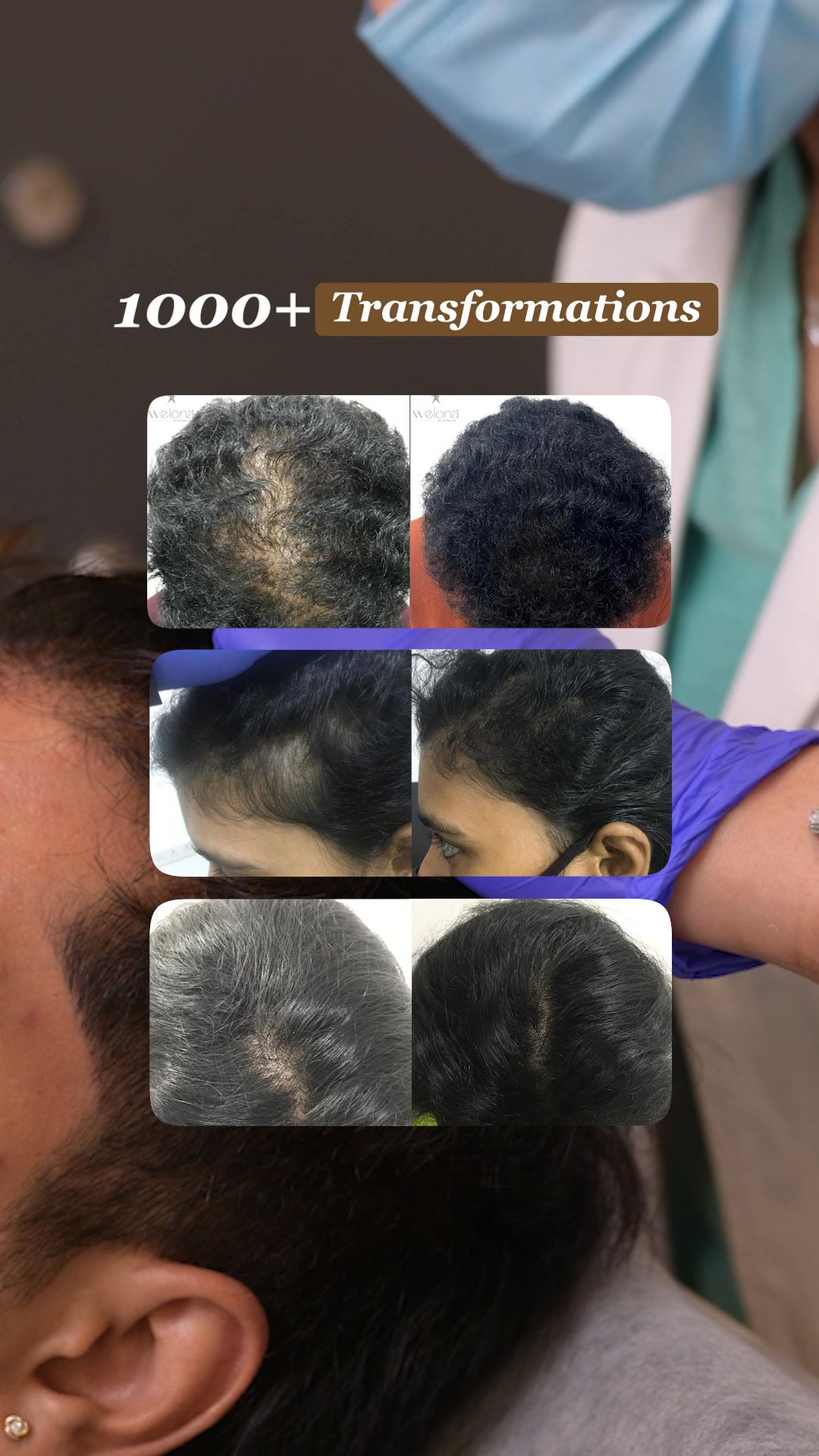Welonaaesthetics Facebook ad: Struggling with Hair Loss?