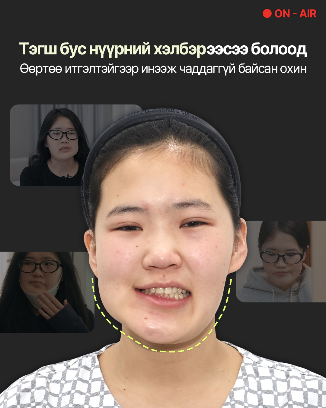 1% Гоо сайхны мэс заслын эмнэлэг Facebook ad: Хүнд хэлбэрийн нүүрний тэгш хэмийн алдагдалтай Монгол охины…