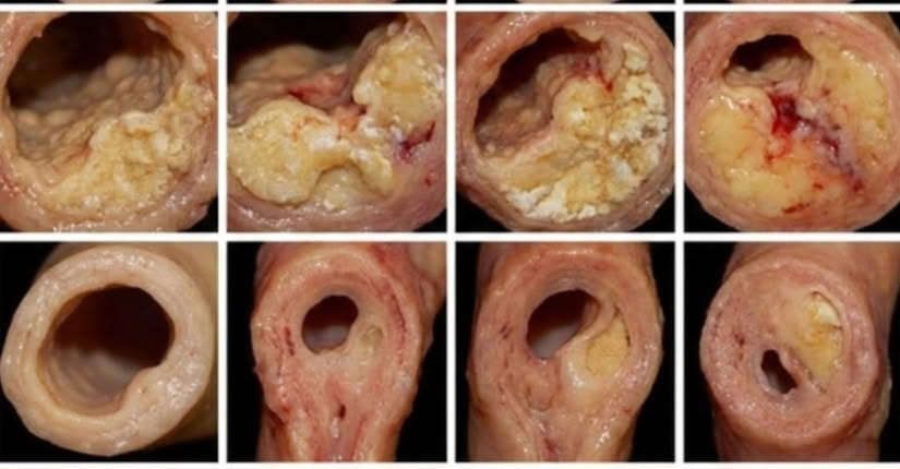 The Cholesterol Circle. Facebook ad