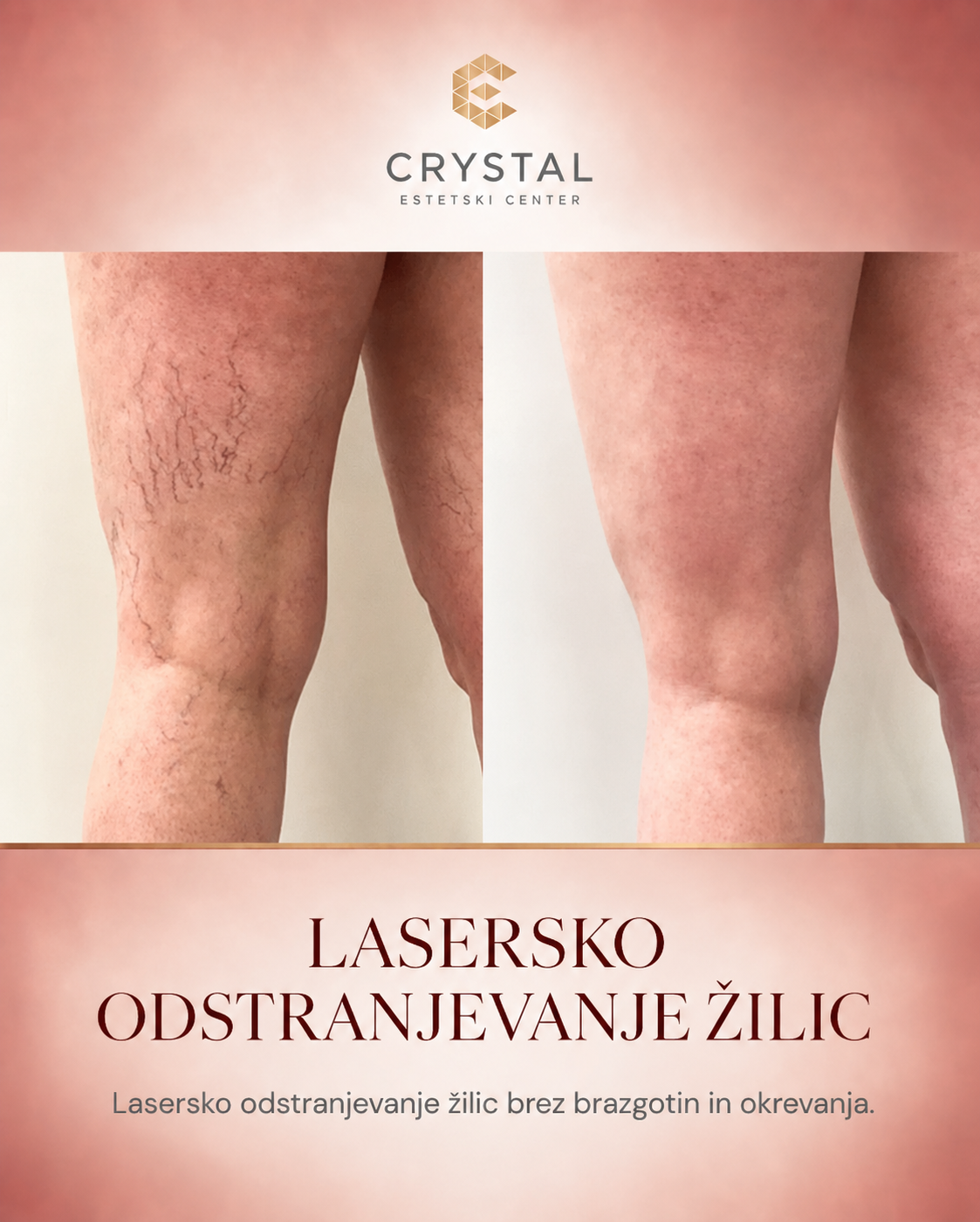 Estetski center Crystal Facebook ad: ŽILICE?