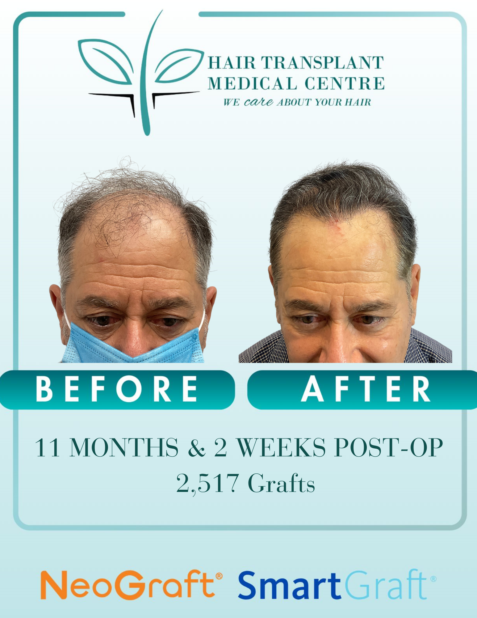 Hair Transplant Medical Centre Facebook ad