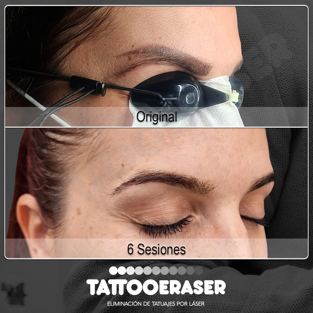 Tattoo Eraser Facebook ad: En este caso, la paciente ha necesitado 6…