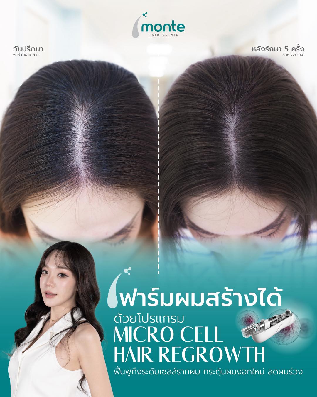 Monte Clinic - Hair Transplant ปลูกผมถาวร คิ้ว หนวดเครา รักษาผมบาง Facebook ad
