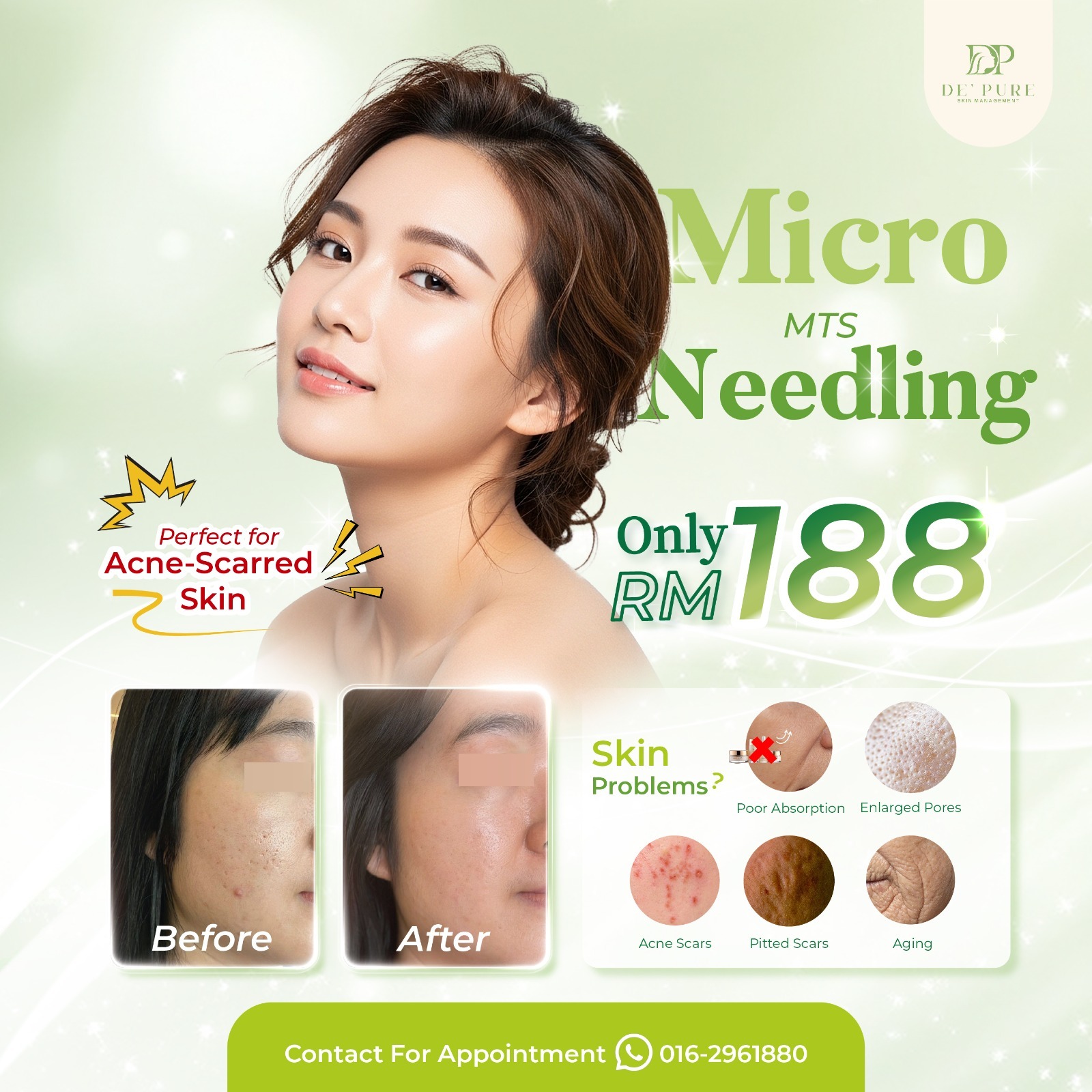 De Pure Skin Management Ipoh Facebook ad: The solution for acne-scarred skin, only RM188