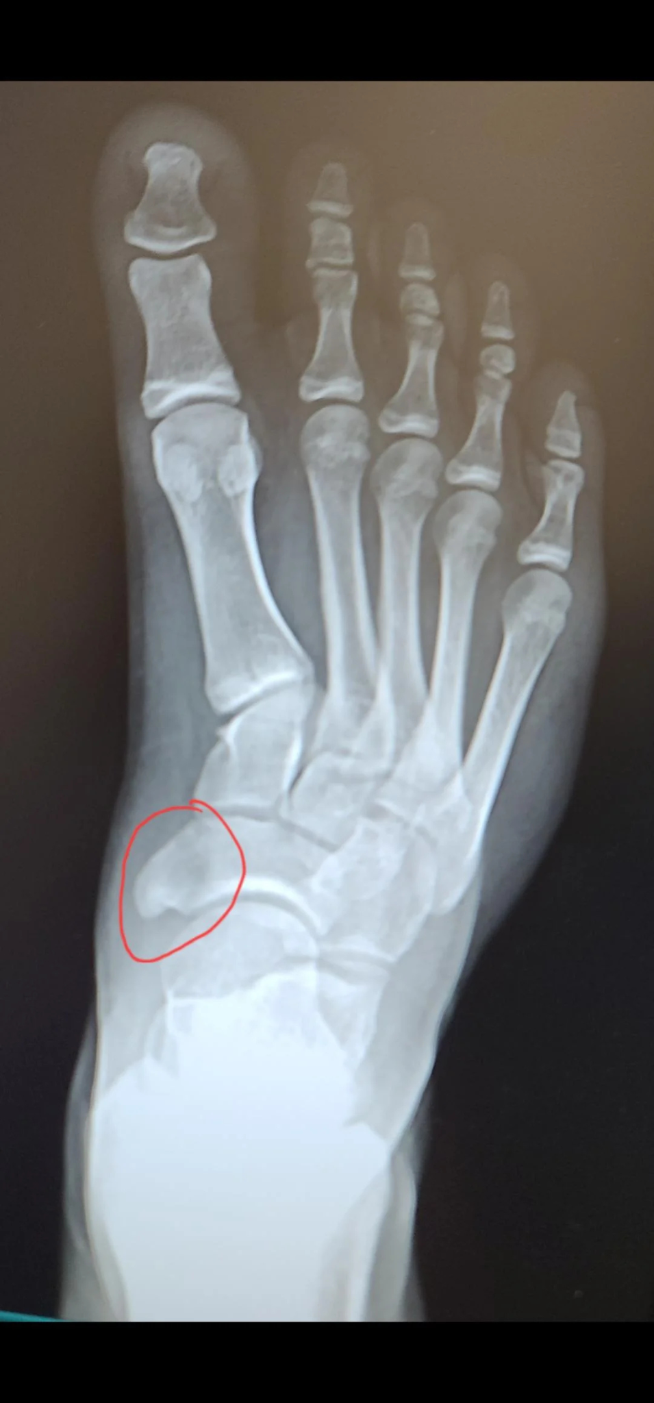 Dr. Elliot Johnson Facebook ad: Neurologist: Neuropathy Isn't A Pain Problem At All