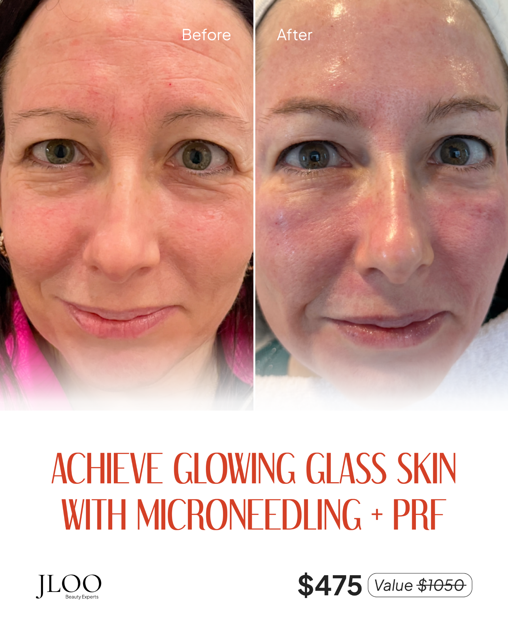 JLoo Beauty Experts Facebook ad: Achieve Glass Skin Glow With Microneedling + PRF