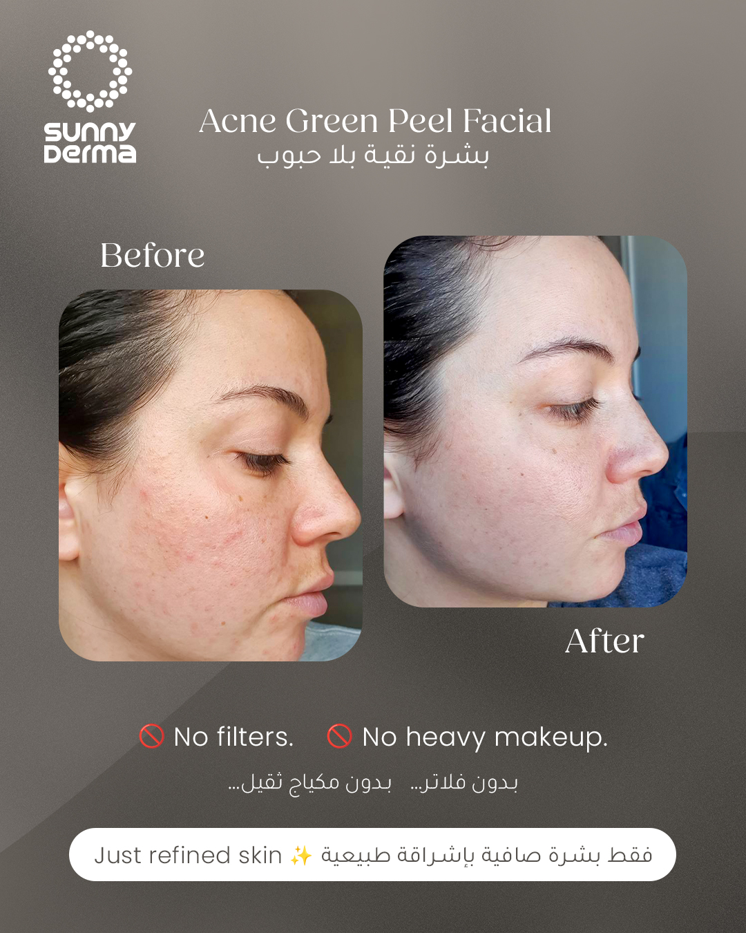 Sunny Derma Facebook ad: Acne-free skin this Ramadan… What's the secret?