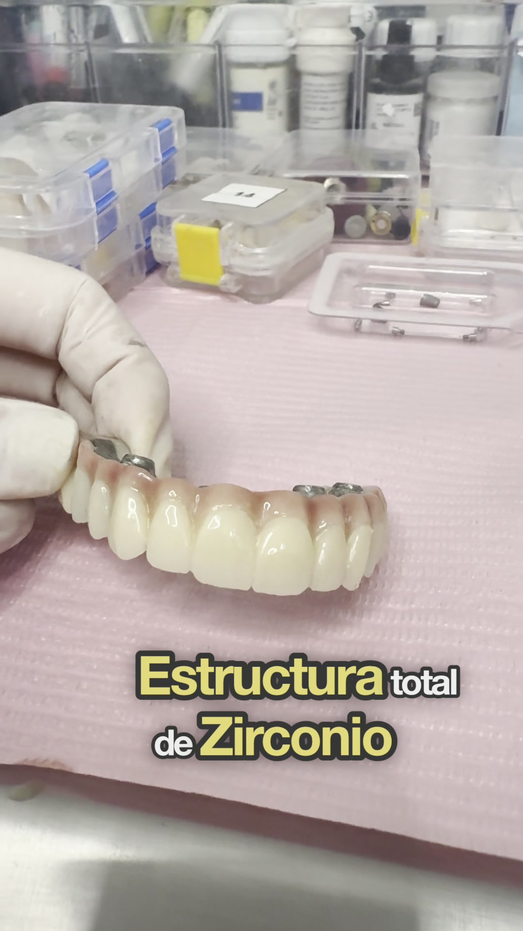 Clinica Dental Zenit Las Condes Facebook ad: Barra de titanio