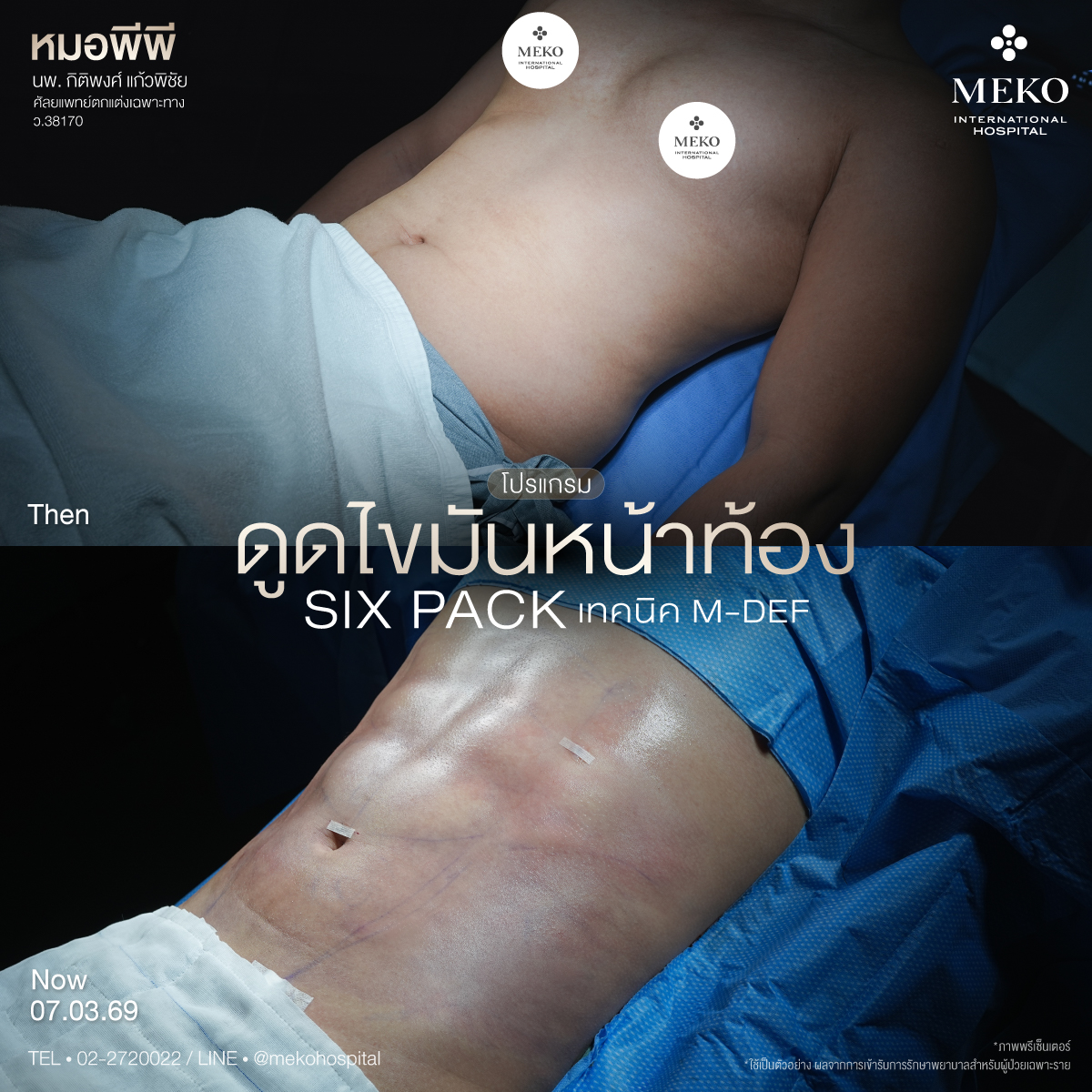 ดูดไขมัน ตัดหนังหน้าท้อง by Meko Hospital Facebook ad