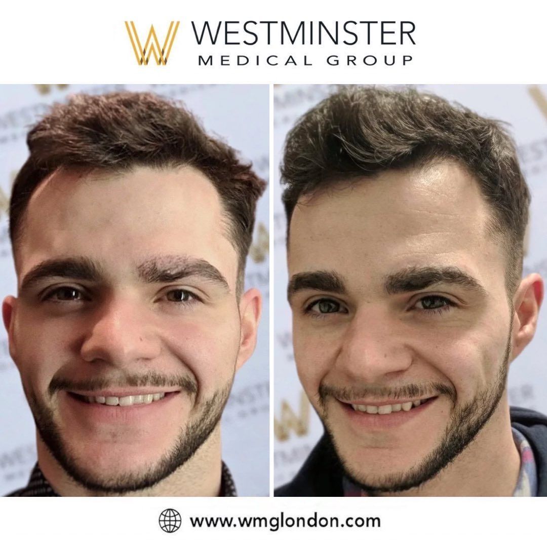 Westminster Medical Group Facebook ad: This gentleman had an FUE eyebrow transplant at…