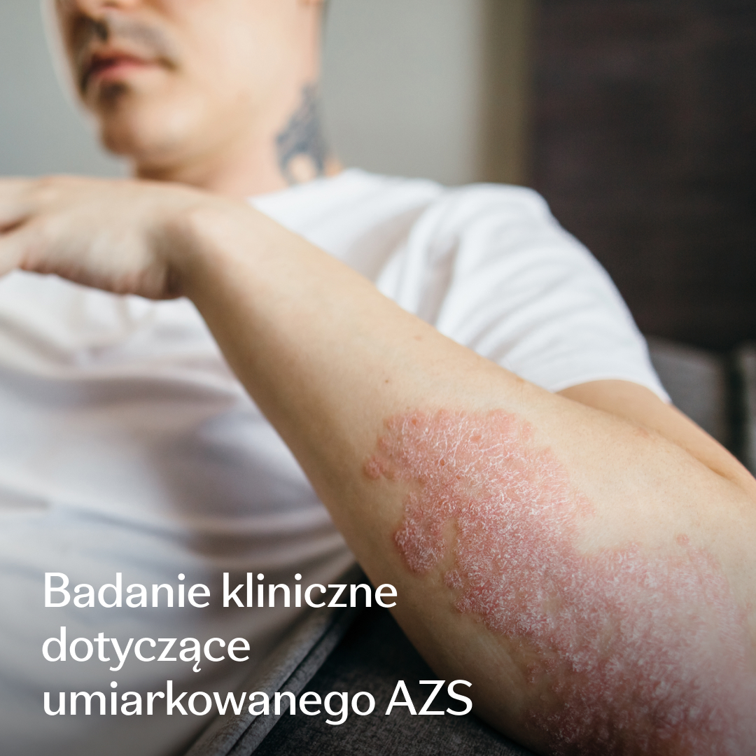 Eczema Research Study Facebook ad: Rozwój badań naukowych