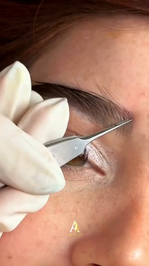 Amir Beladi Polyclinic Facebook ad: Eyebrow Transplant in Dubai