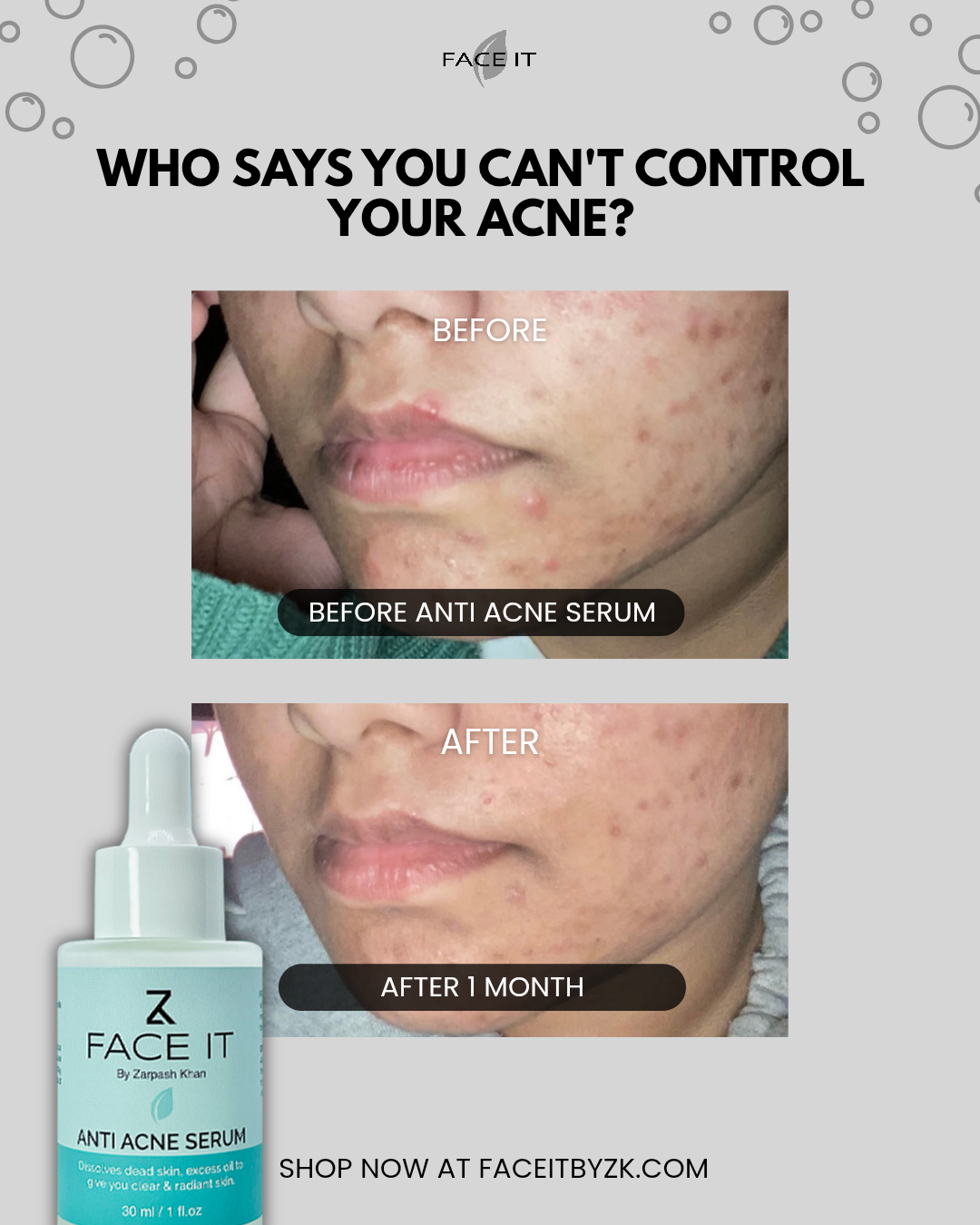 𝖥𝖠𝖢𝖤 𝖨𝖳 Facebook ad: Acne Again?