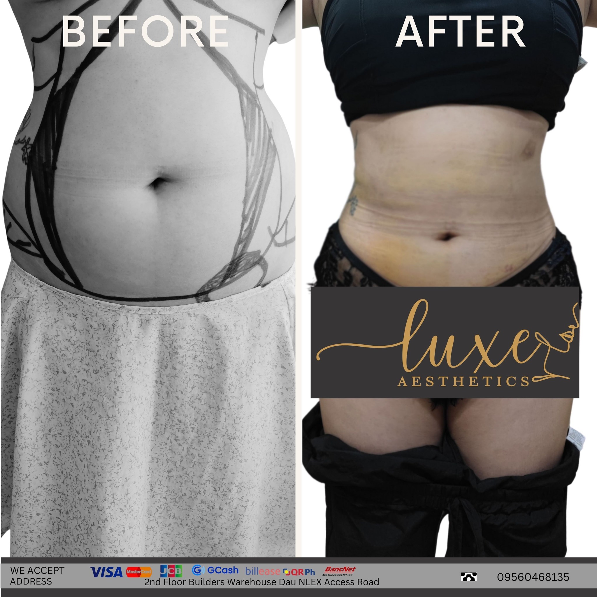 Luxe Aesthetics Facebook ad: Flat Tummy in Just One Procedure!