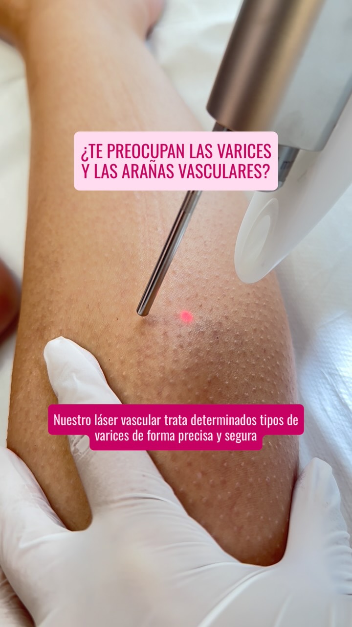 Clínicas Dorsia Facebook ad: ¿Te preocupan las pequeñas varices y arañas vasculares?