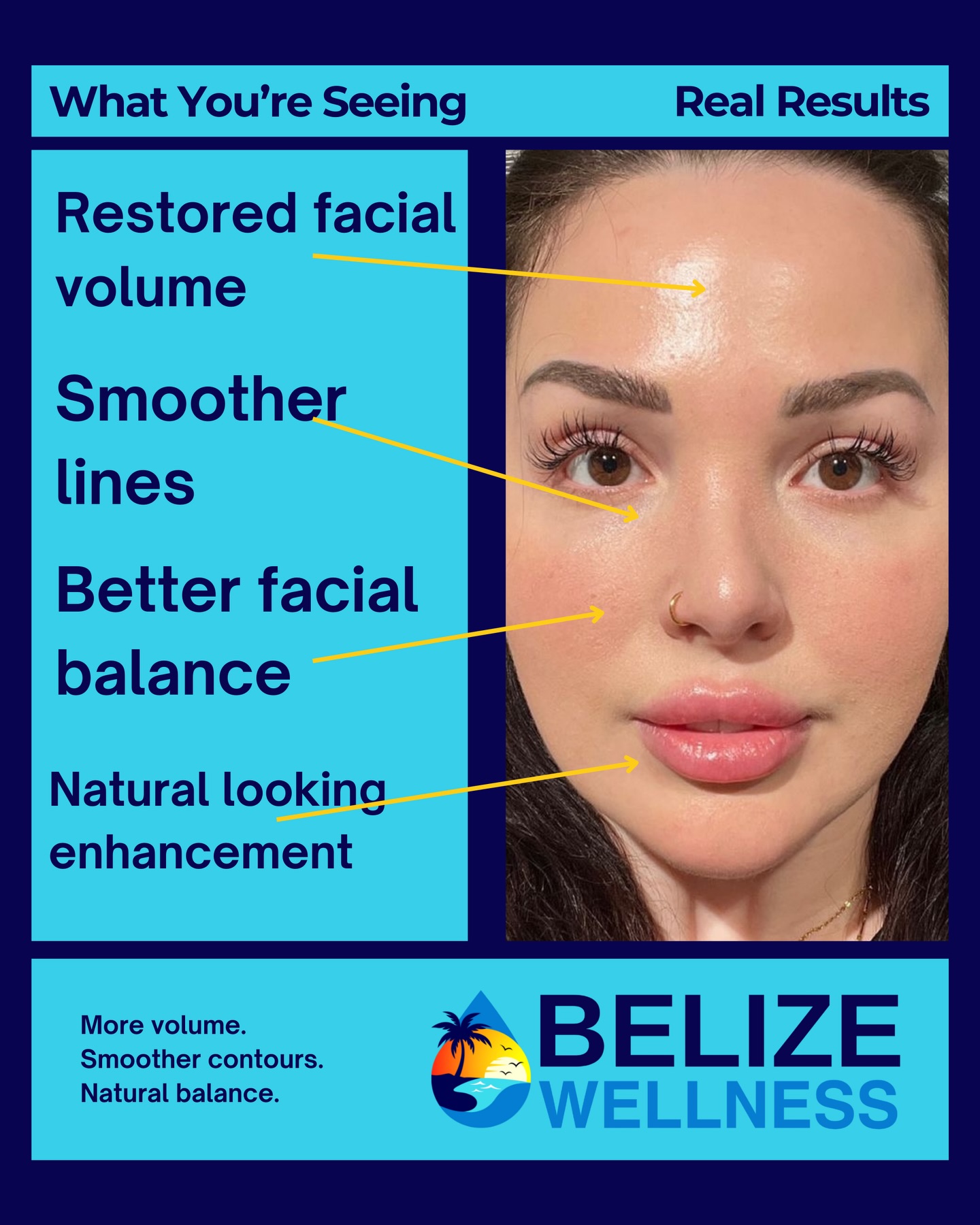 Belize Wellness Facebook ad: Dermal Fillers in San Pedro Belize