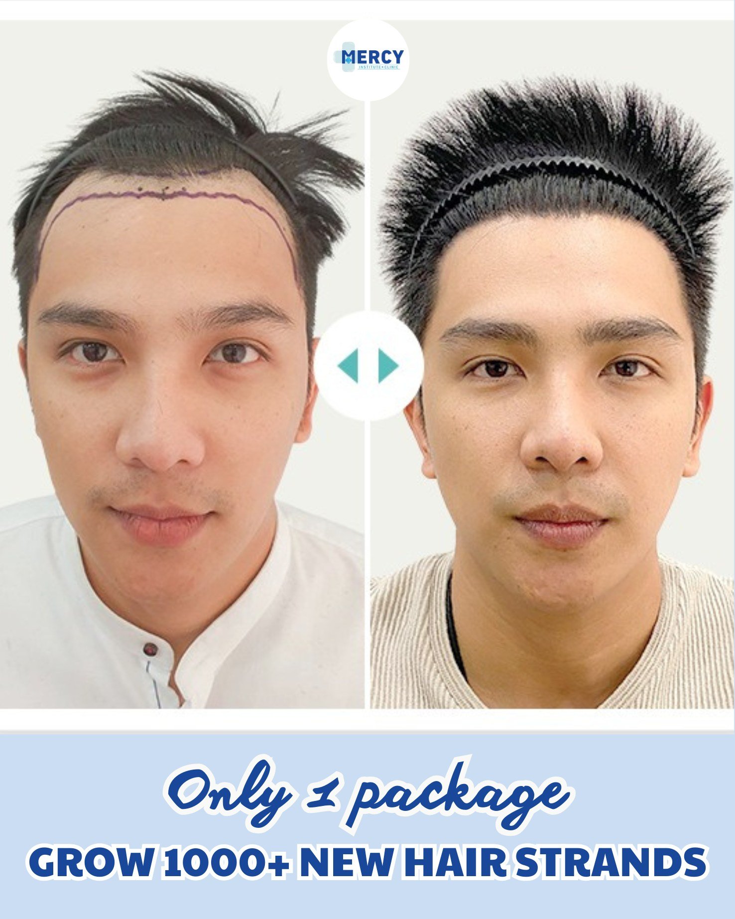 Mercy Hair Regrowth Institute - Davao City. Facebook ad: BALDNESS, THIN HAIR, LOSS OF HAIR?