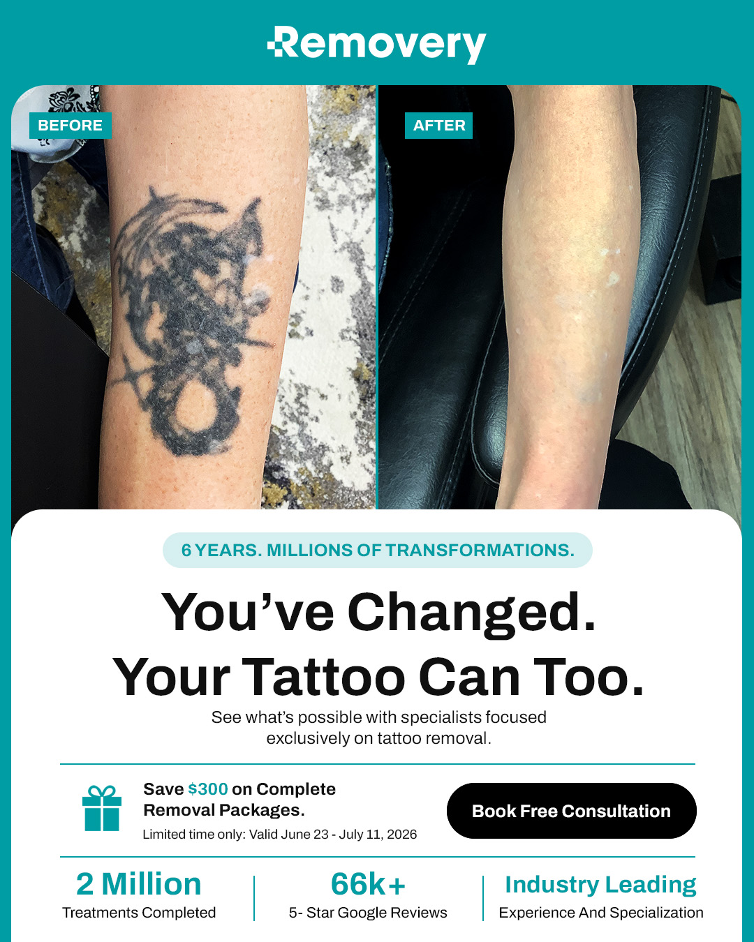 Removery Facebook ad: $300 Off Complete Tattoo Removal Packages.