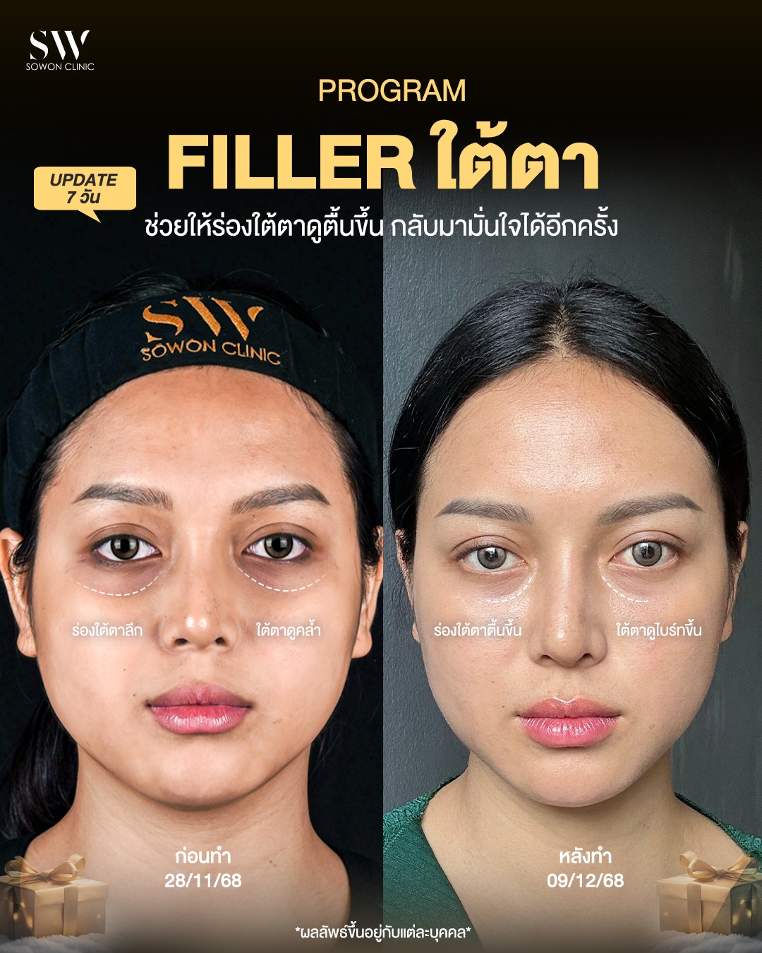Sowon clinic Botox Filler HIFU ร้อยไหม โบท็อกซ์ ฟิลเลอร์ ปรับรูปหน้า Facebook ad