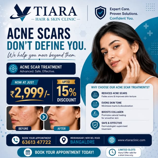 Vtiara Clinic Facebook ad: Best Acne Scar Treatment