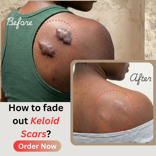 Herbal Action Remedy Facebook ad: Fade old & new scars ASAP
