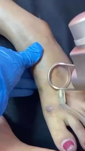 HP Aesthetic Clinic - Zabarte North Caloocan Facebook ad: NO MORE OLD SCAR IN 3SES!