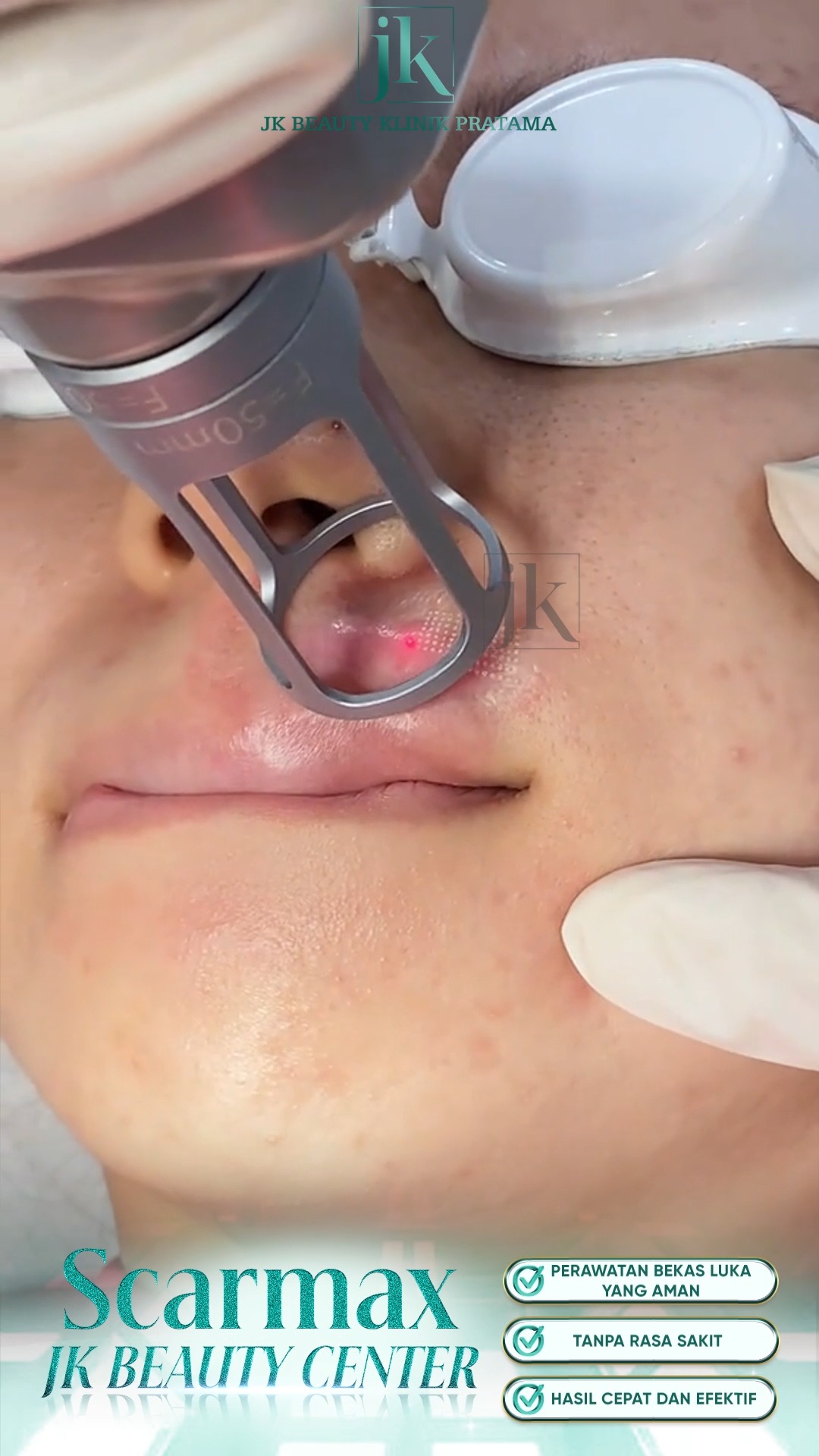 Scarmax - JK Beauty Klinik Pratama Facebook ad: Bekas luka keloid di bibir, Bukan lagi mimpi…