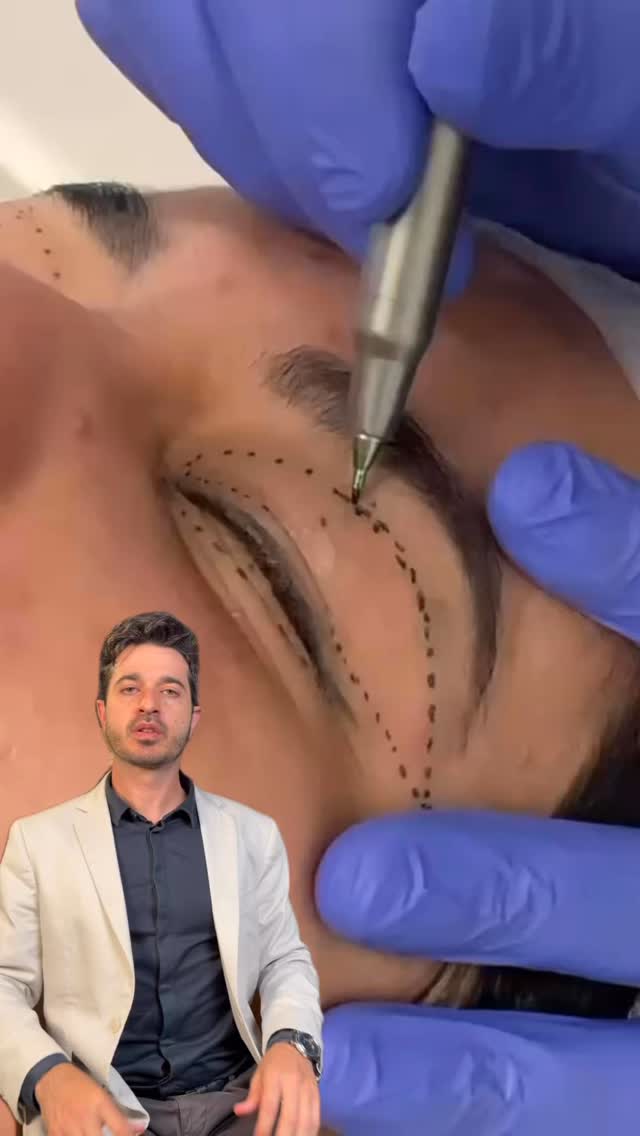Dr. Guilherme Sabbag - Blefaroplastia Facebook ad: TÉCNICA MODERNA MUITO USADA HOJE