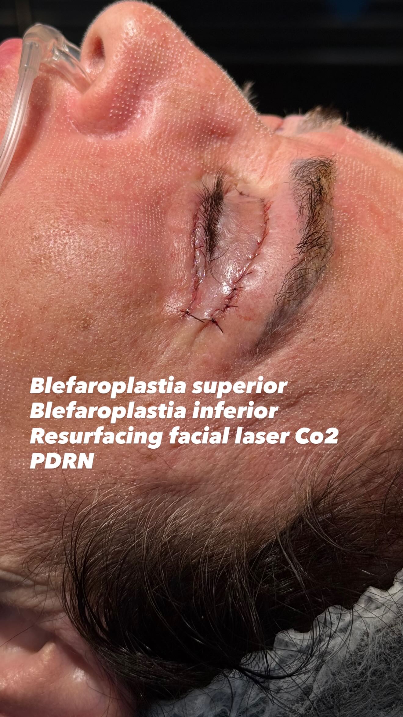 Dr. Diogo Silveira Facebook ad: Blefaroplastia superior