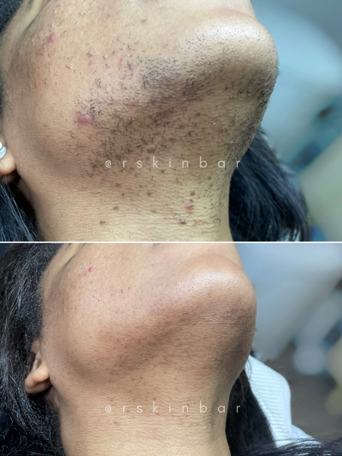 R Skin Bar Facebook ad: Pseudofolliculitis Barbae happens when curly or coarse…