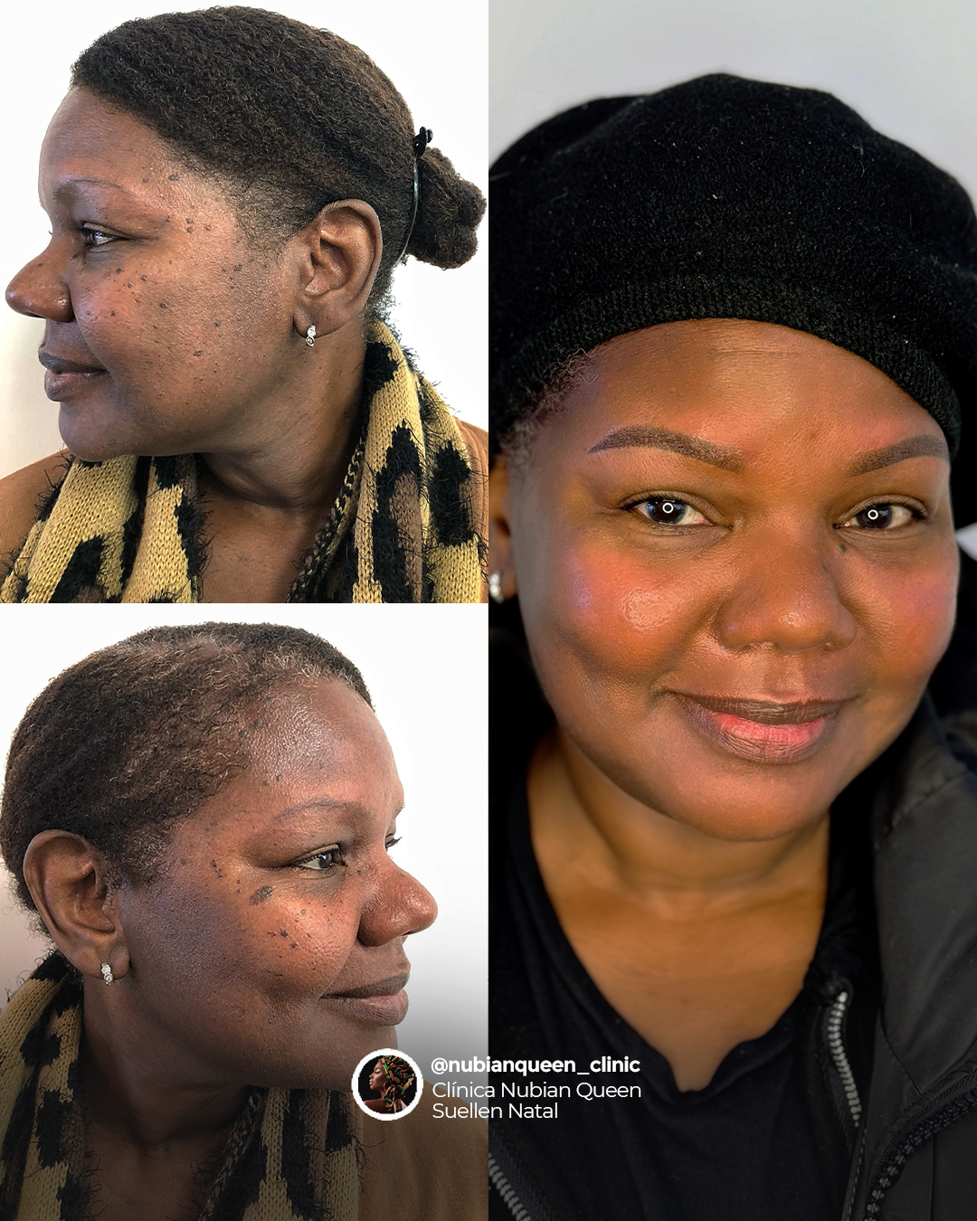 Nubian Queen Clinic em Amadora Facebook ad: Quase a fazer 60 anos… mas a pele?