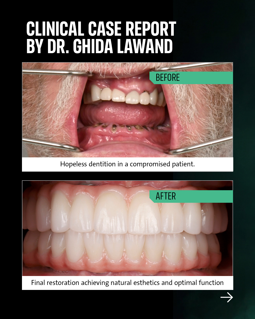 Straumann Facebook ad: A 62-year-old patient with severely deteriorated dentition…