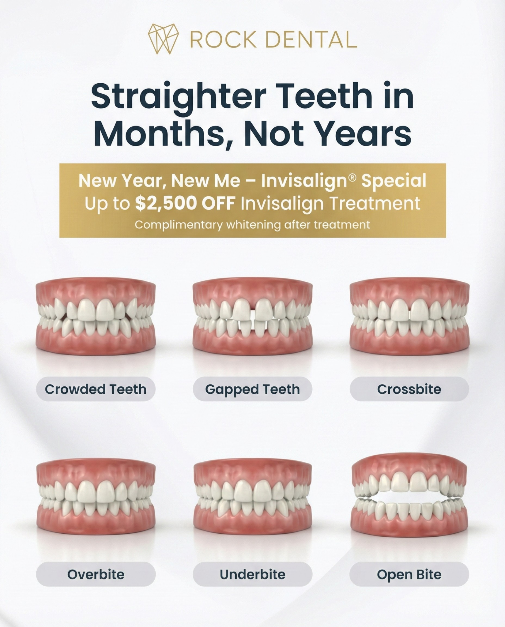 Rock Dental Facebook ad: Exclusive White Rock's Deal: $2500 OFF On Invisalign…