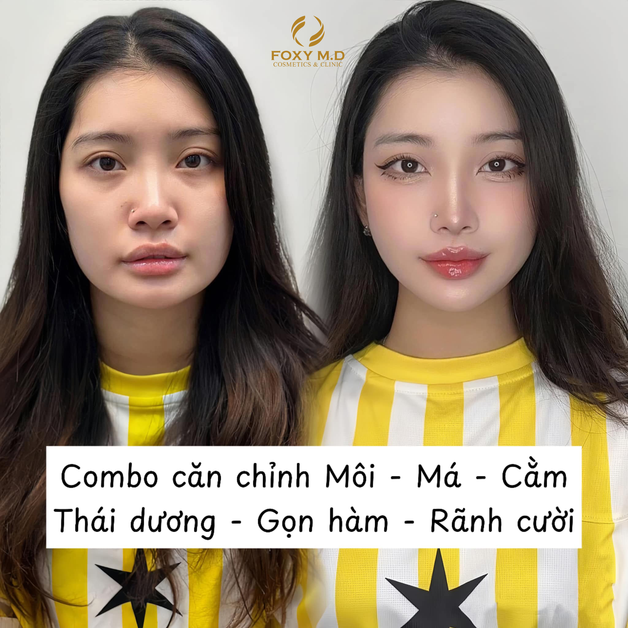 Tiêm Filler Botox uy tín tại Đà Nẵng - Foxy M.D Clinic Facebook ad: ĐỪNG CHỈ AO ƯỚC NÉT ĐẸP CỦA NGƯỜI…
