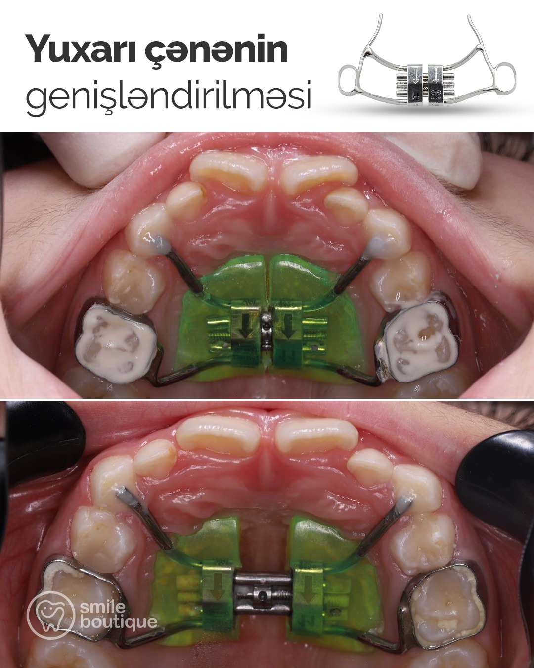 Smile Boutique Facebook ad: Əvvəl-sonra nəticəsi bir daha göstərir ki, düzgün…