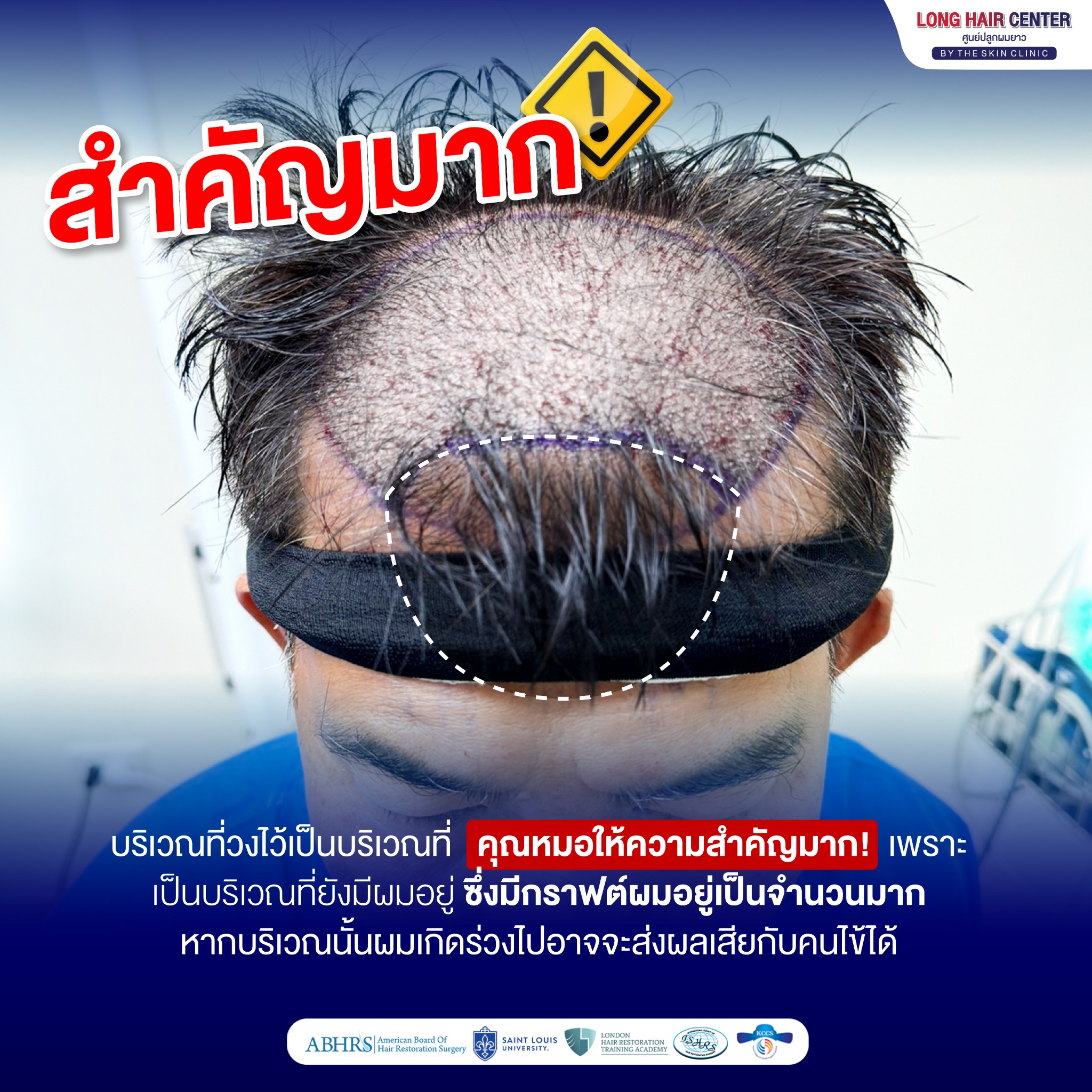 หมอท็อป ปลูกผม The skin clinic แพทย์อเมริกันบอร์ด - International Speaker Facebook ad: คุณกำลังเจอปัญหาเกี่ยวกับเส้นผมอะไรอยู่