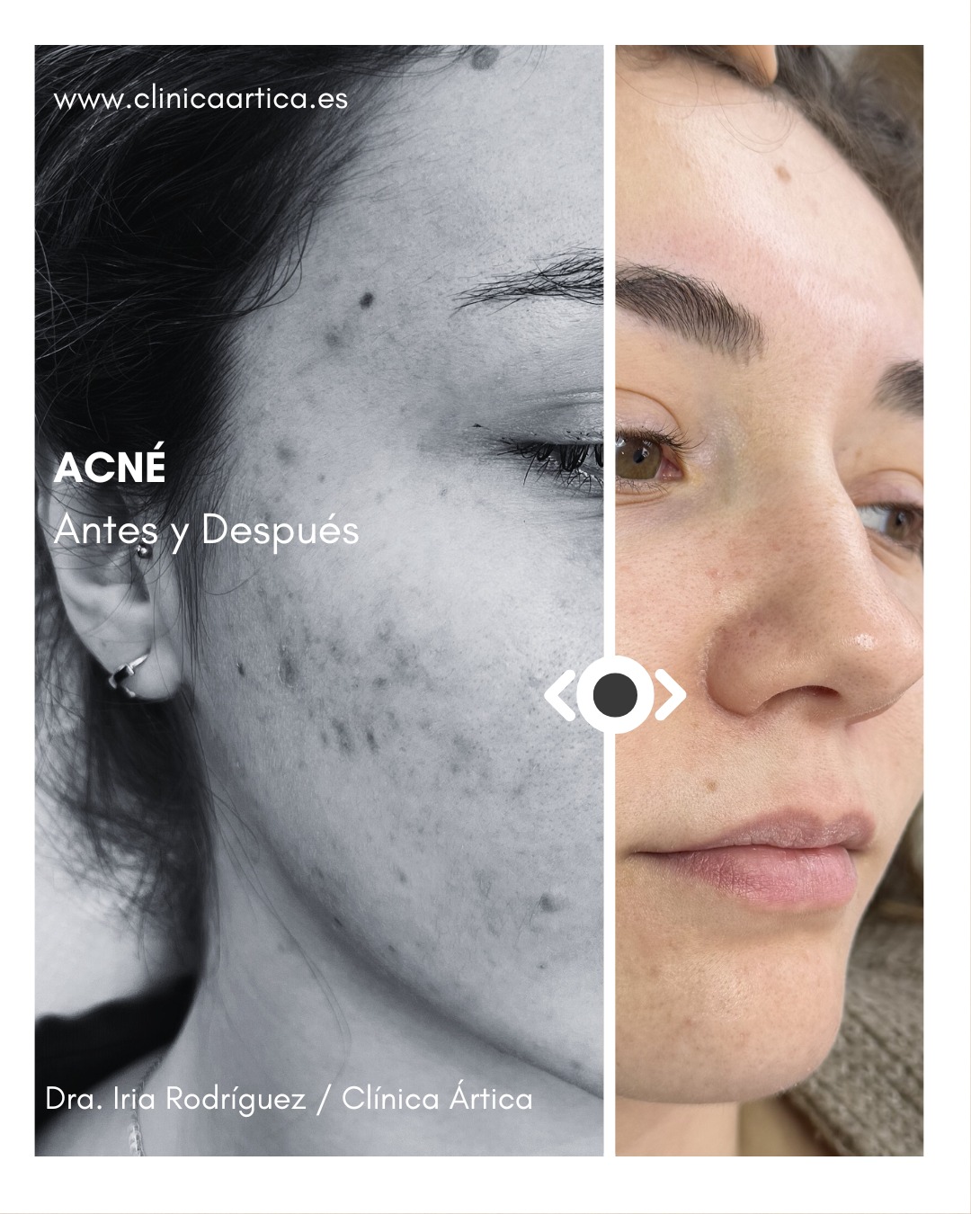 Ártica Medicina Estética Facebook ad: ACNÉ - MÉTODO ÁRTICA