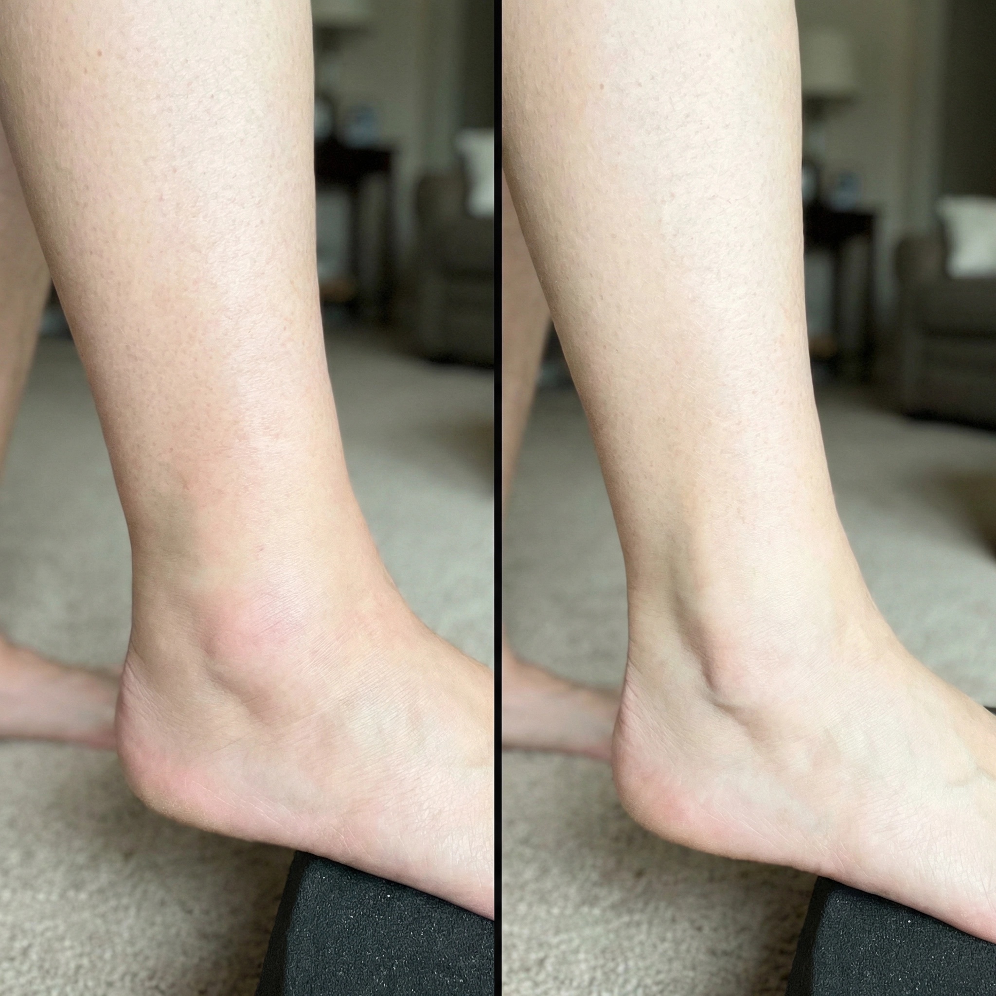 Lymphedema Support Group Facebook ad: Read this if you're wearing compression stockings every day