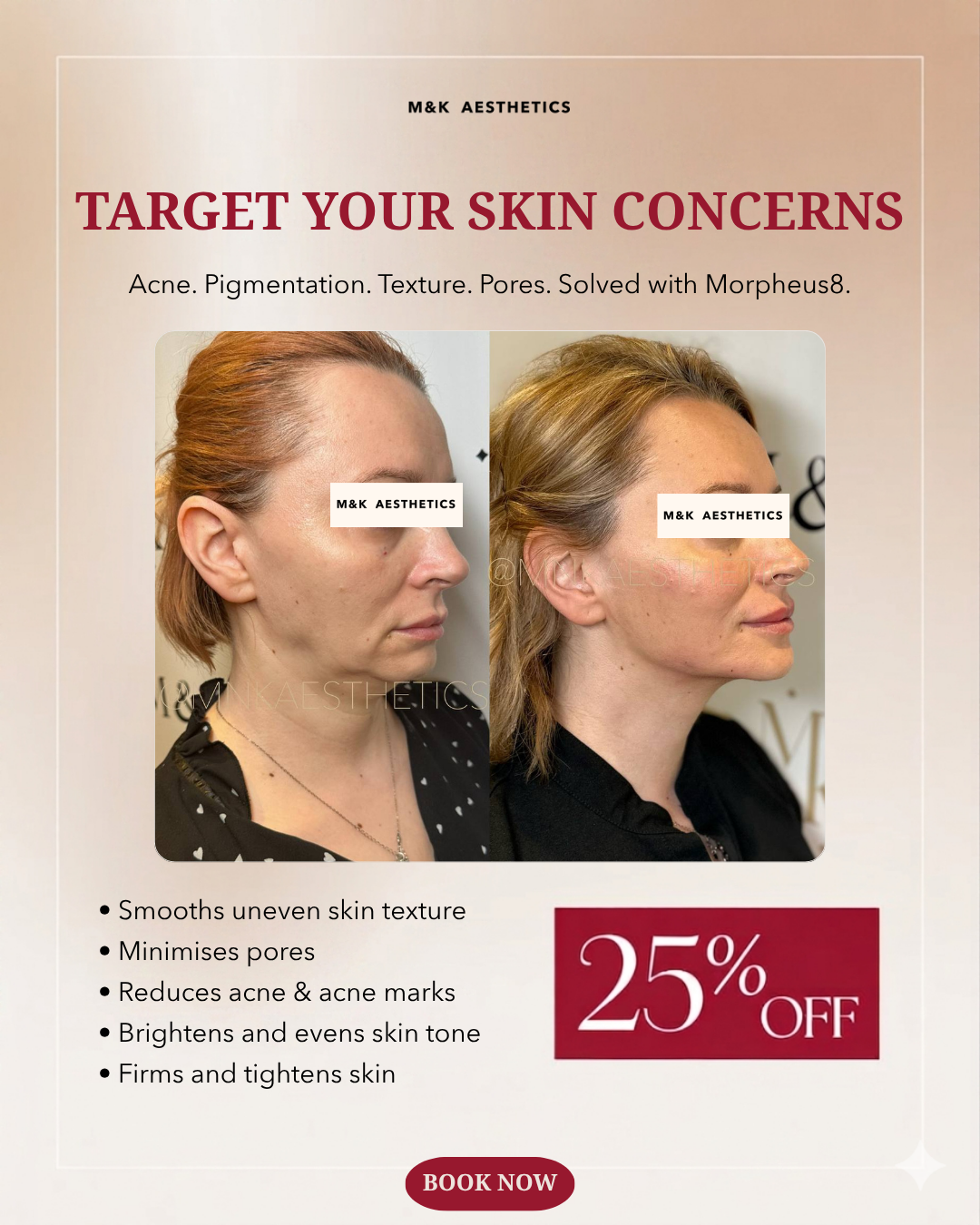 M&K Aesthetics Facebook ad: 25% OFF Morpheus8, Reduce Scars, Pores & Wrinkles